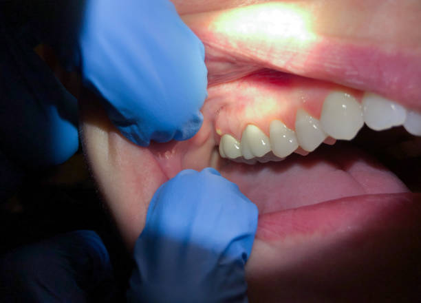 Best Emergency Dental Care for Broken or Chipped Teeth in Lake Ozark, MO